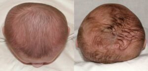 Vista cenital del cráneo de dos bebés con braquicefalia 