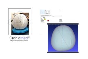 Validación técnica de CraniaMed frente a escáner 3D: cómo estamos evaluando su precisión