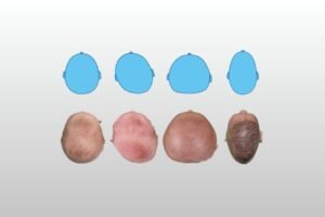 Qué es la plagiocefalia y cómo se mide correctamente en bebés