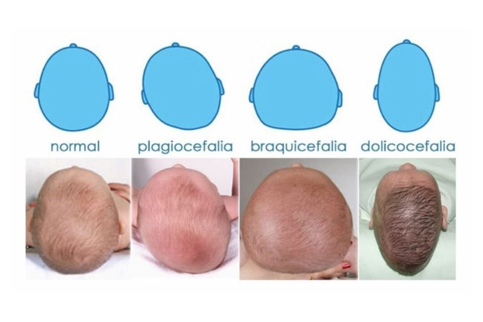Imagen con 4 tipos de plagiocefalia vista desde arriba