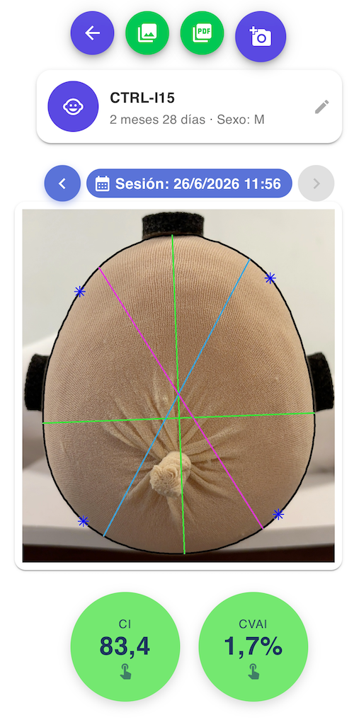 App de CraniaMed calculando el CVAI durante la ventana de intervención craneal en un bebé
